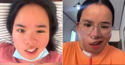 吹风扇入睡近4小时 女子醒来“面瘫”嘴歪眼斜