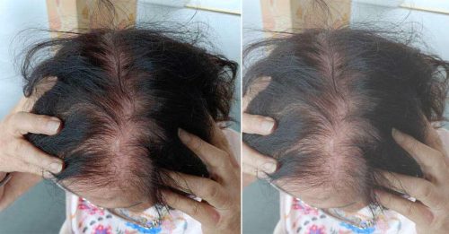 老妇染发过敏住院 理发院坚持没错 退款补偿她医药费