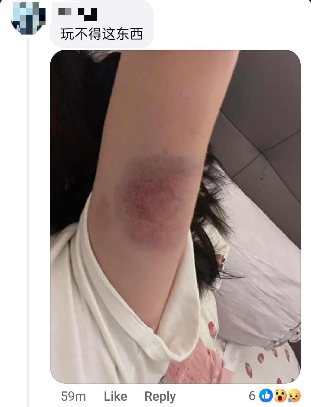 数名伤者事后在视频留言区张贴受伤的照片。