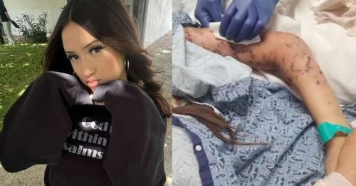 遭16只狗咬 缝500针 少女：“我还漂亮吗？”