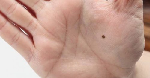快检查！生殖器有痣很危险！专家：或变皮肤癌