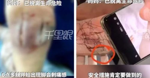 沙滩赤脚踩死鱼 童染菌 险截肢