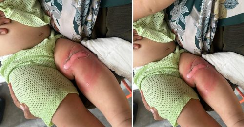 疑保母没关防护栏 婴儿打翻热水壶烫伤