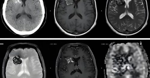 员工脑血管有瘤 拒夜班被裁 公司被判赔