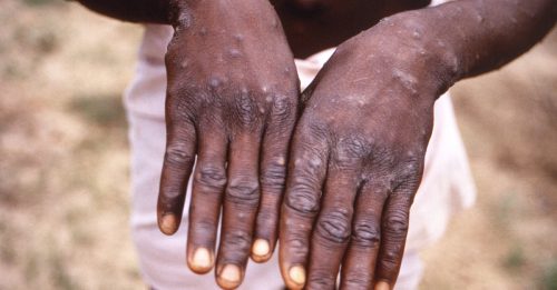 世卫组织宣布：M痘疫情 不再构成国际公卫紧急事件