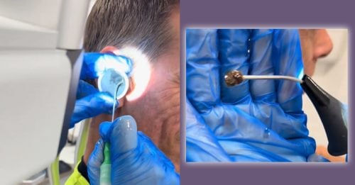 男子耳鸣听不到 挖出超大块耳屎