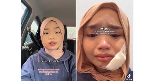 挤痘痘挤到脸肿生脓！女子分享惨痛经历