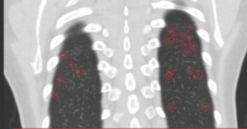 60岁女满天星肺结节 医生急劝快换工作
