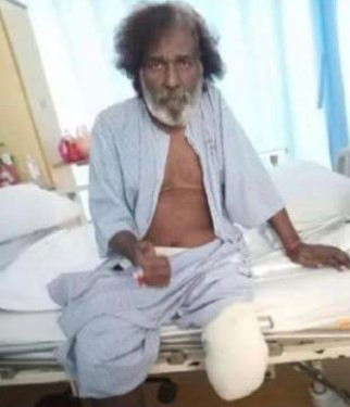 萨迪亚因严重糖尿病而被迫截肢。