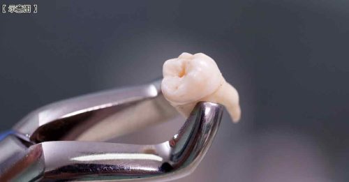 男子怀疑女友出轨 强行拔掉她8颗牙