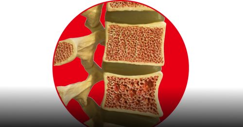 健康百科｜胃药害人骨质疏松？!