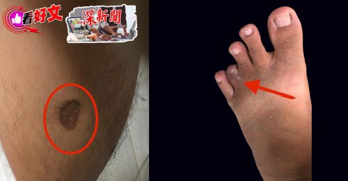 独家-深新闻｜高薪代购是骗局．踏入园区困2年 猪仔逃亡失败切脚趾