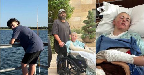 模仿Tik Tok酒精实验 12岁男全身重度烧伤