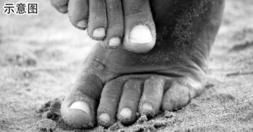 糖尿病男剪趾甲破皮 切除10根脚趾保命