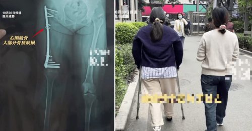 女生自15岁摔伤 11年植骨 4次均溶解