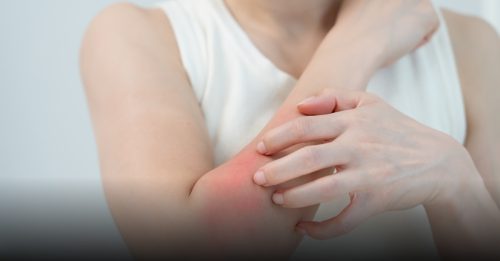 健康百科｜用力抓 皮肤更痒