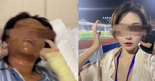 开包裹突爆炸 女主播严重毁容 双眼肿剩一条线