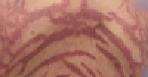 女子盲涂网红药膏10年 全身长满恐怖蛇纹