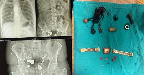 男子腹痛连日呕吐 体内竟有手表、铁片、大理石块……