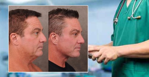 矽谷男高管陷容貌焦虑 30岁打瘦脸针 40岁动刀