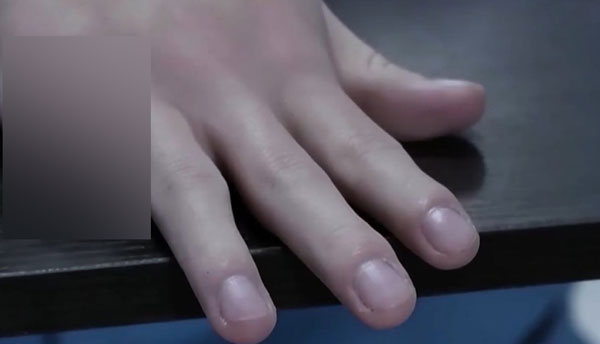 受害人手指被斩去。
