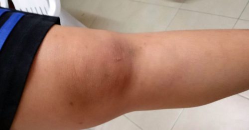 被嘲笑“胖子”引冲突 男学生咬对方手 反遭3同学围殴