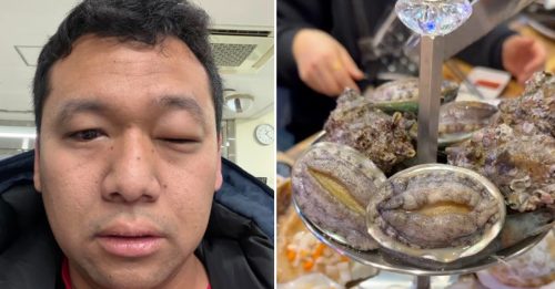开心游韩国变“脸肿记” 大马男海鲜过敏急求医