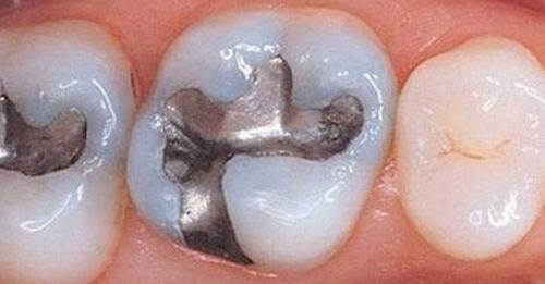 各国同意2034年前 淘汰含汞牙科填充物