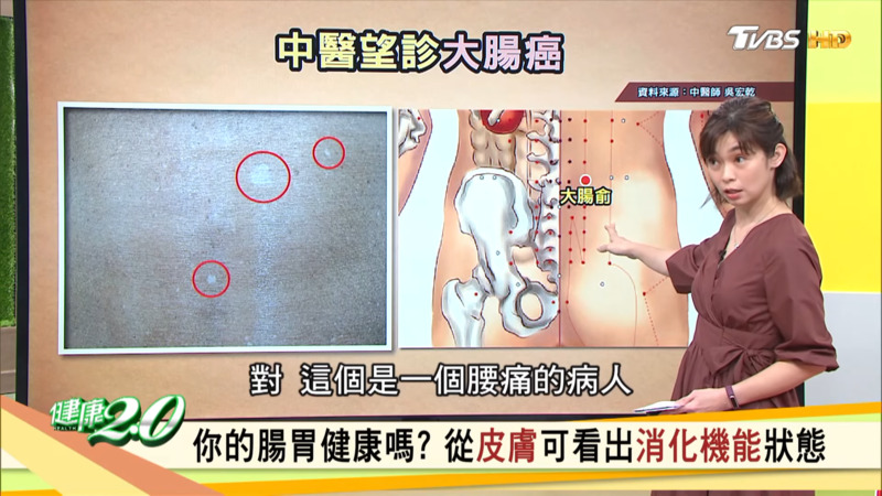 从背部“大肠俞”部位也可以看出端倪。
