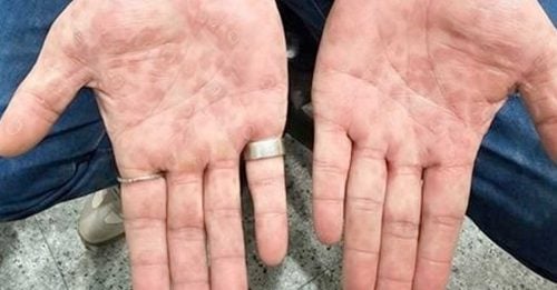 年轻男去露营1个月后 手掌现红斑点 感染梅毒！