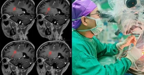 男子癫痫20年 颅内取出10公分寄生虫