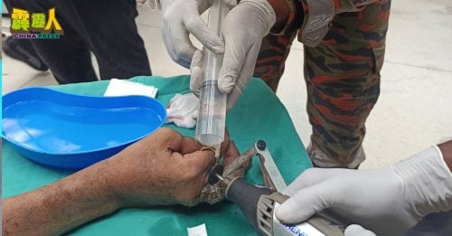 手指严重肿胀瘀黑  全因两枚戒指“作怪”